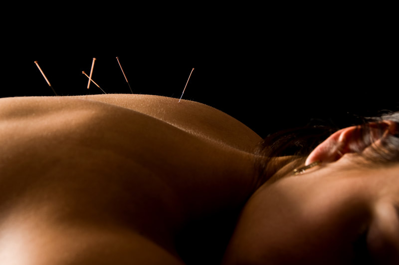Acupuncture, Chinese Medicine